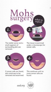 Tennessee Skin Cancer Surgery Procedure